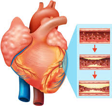Understanding Cardiovascular Diseases: A Global Health Priority